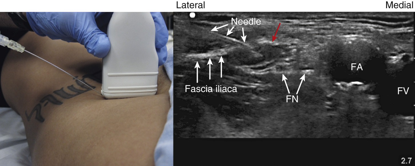 A patient undergoing ultrasound guided femoral nerve block with needle insertion and labeled structures.